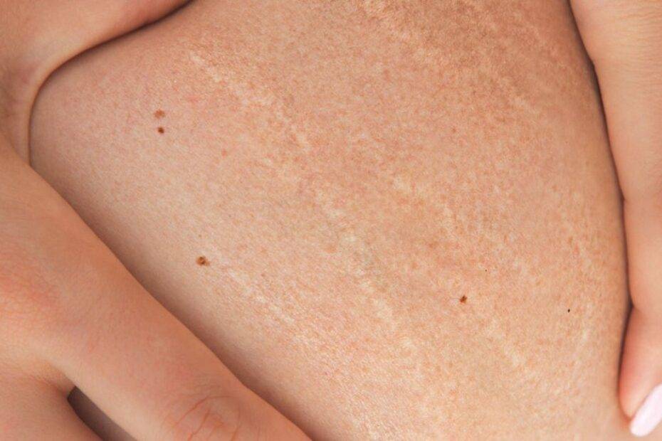 Stretch Marks