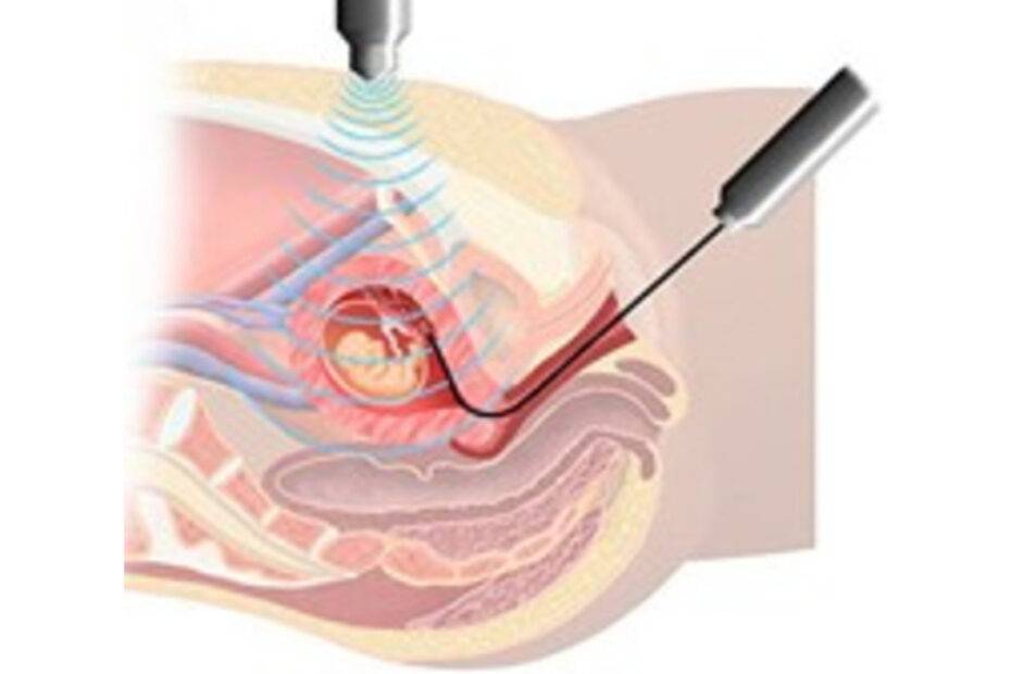 What is Chorionic Villus Sampling